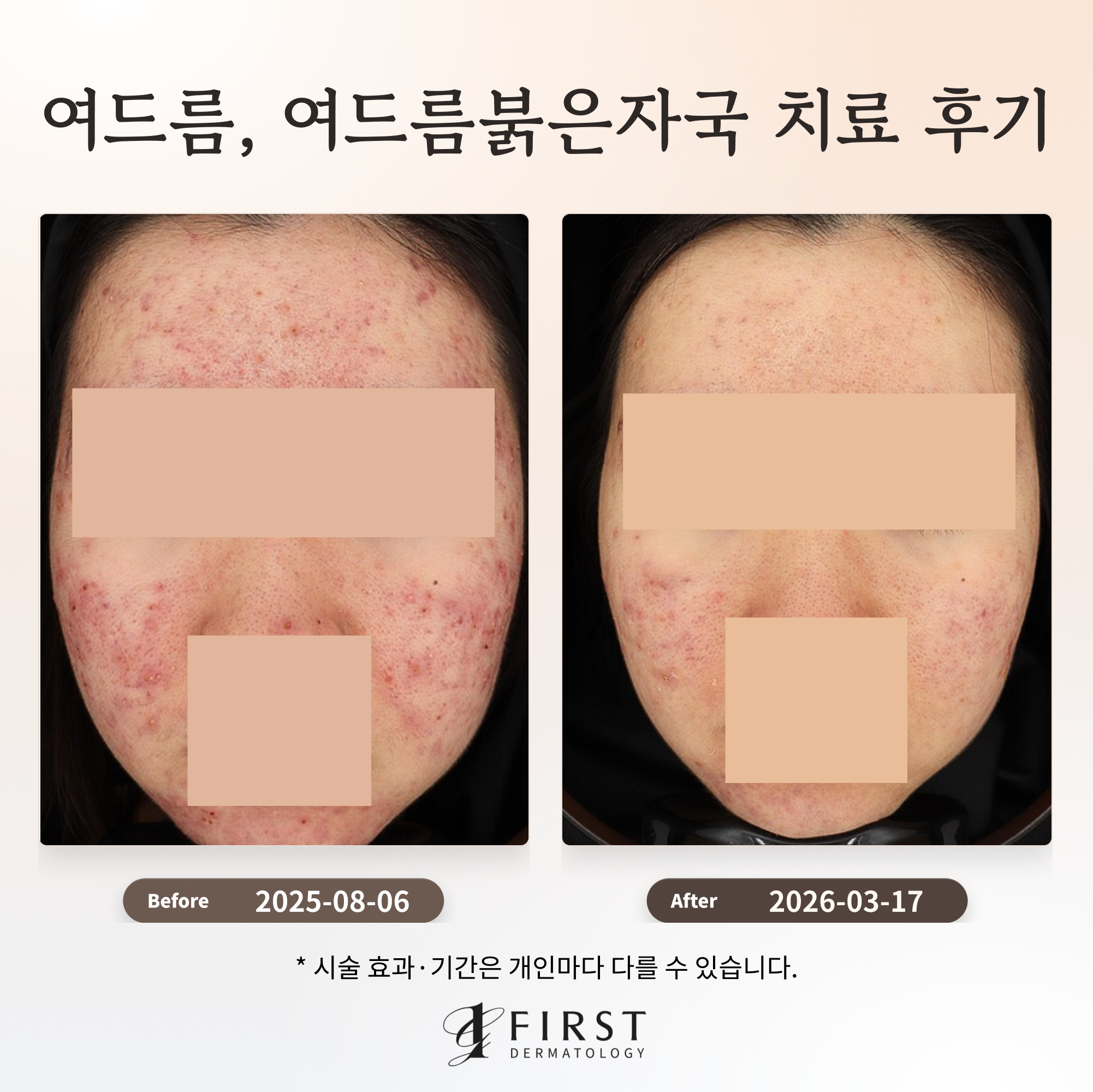 여드름, 여드름붉은자국 치료 후기