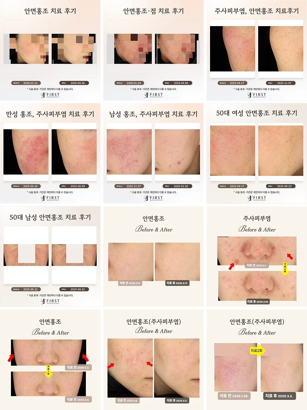 광교 퍼스트 피부과 홍조·주사피부염 치료 사례 모음